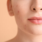 Why Adult Acne Is Stubborn & How Professional Treatments Help | Billies Beauty Bar Aesthetics in Boerne, TX