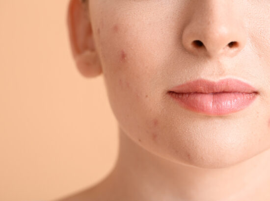 Why Adult Acne Is Stubborn & How Professional Treatments Help