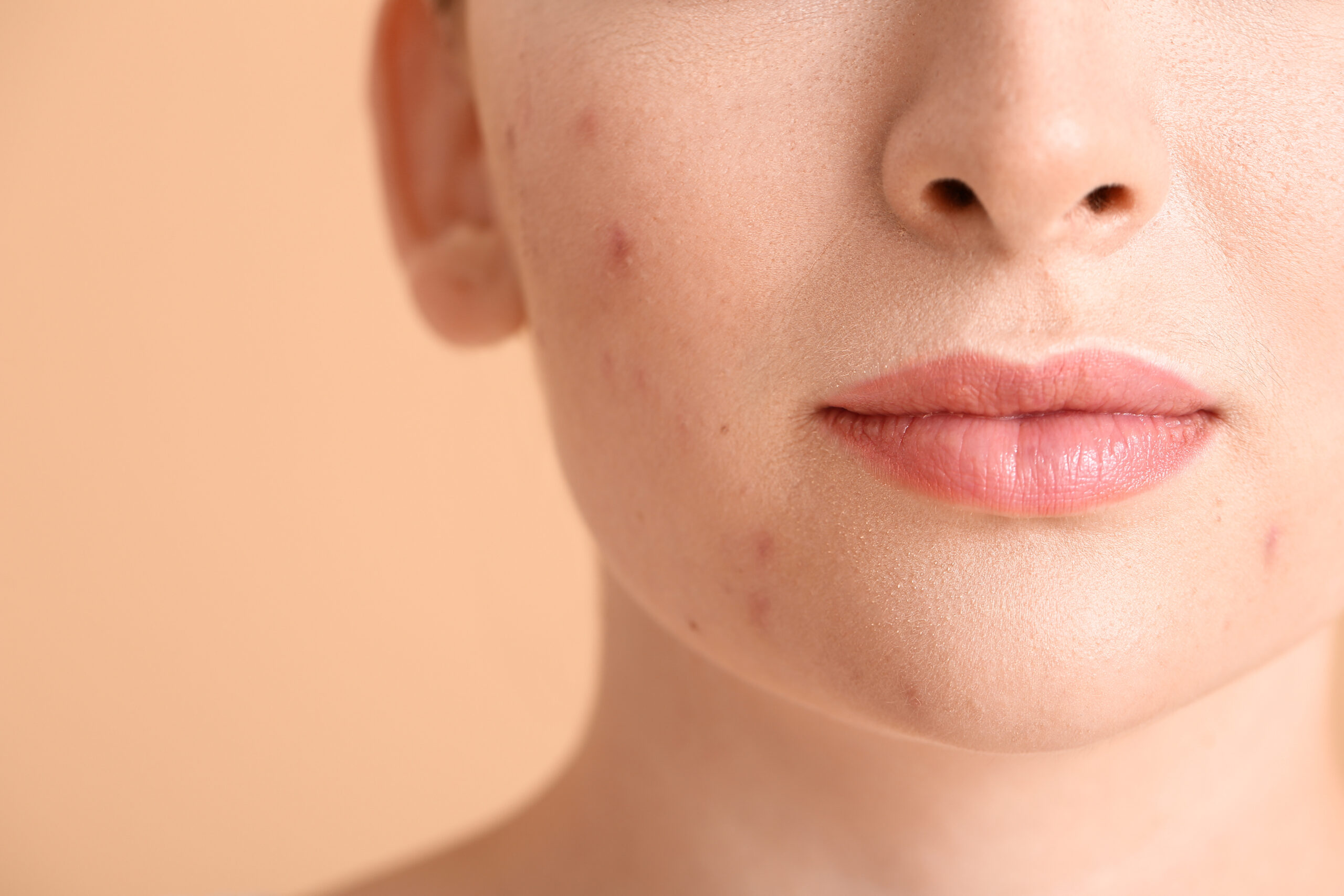 Why Adult Acne Is Stubborn & How Professional Treatments Help | Billies Beauty Bar Aesthetics in Boerne, TX