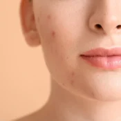 Why Adult Acne Is Stubborn & How Professional Treatments Help | Billies Beauty Bar in Boerne, TX