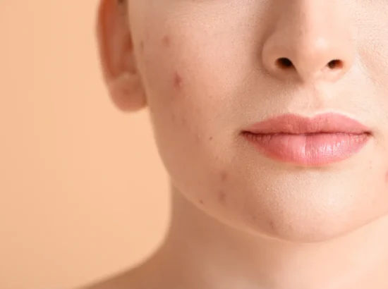 Why Adult Acne Is Stubborn & How Professional Treatments Help