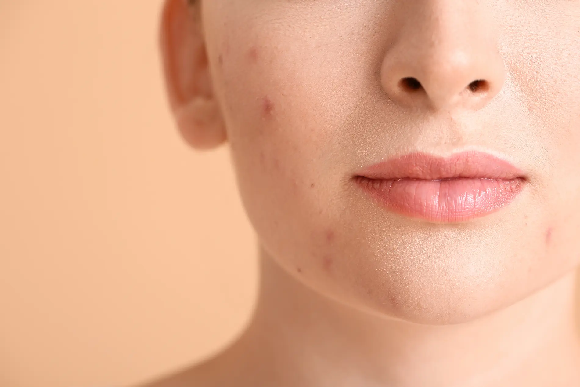 Why Adult Acne Is Stubborn & How Professional Treatments Help | Billies Beauty Bar in Boerne, TX
