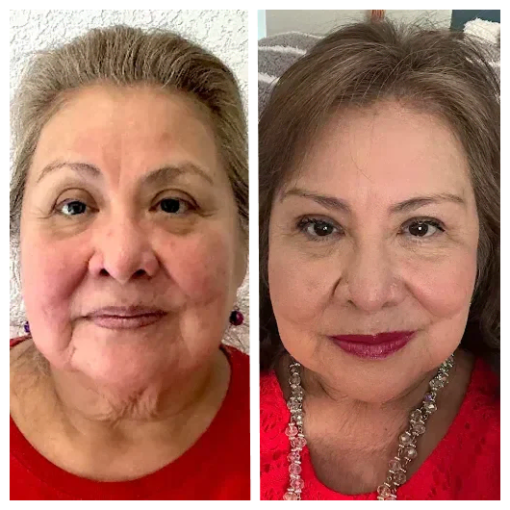 Gallery | Before & After Images of Anti Aging Treatment in Boerne, TX | Billie’s Beauty Bar Aesthetics