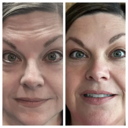 Gallery | Before & After Images of Forehead Lines Treatment in Boerne, TX | Billie’s Beauty Bar Aesthetics