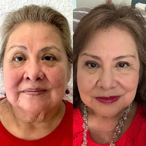 Billie's Beauty Bar Aesthetics before & after