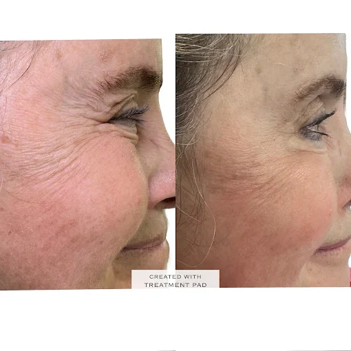 Billie's Beauty Bar Aesthetics before & after