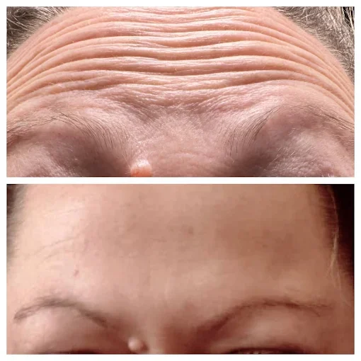 Billie's Beauty Bar Aesthetics before & after