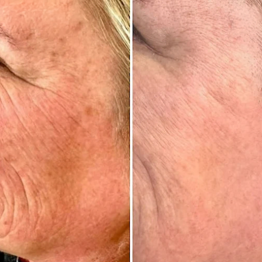 Billie's Beauty Bar Aesthetics before & after